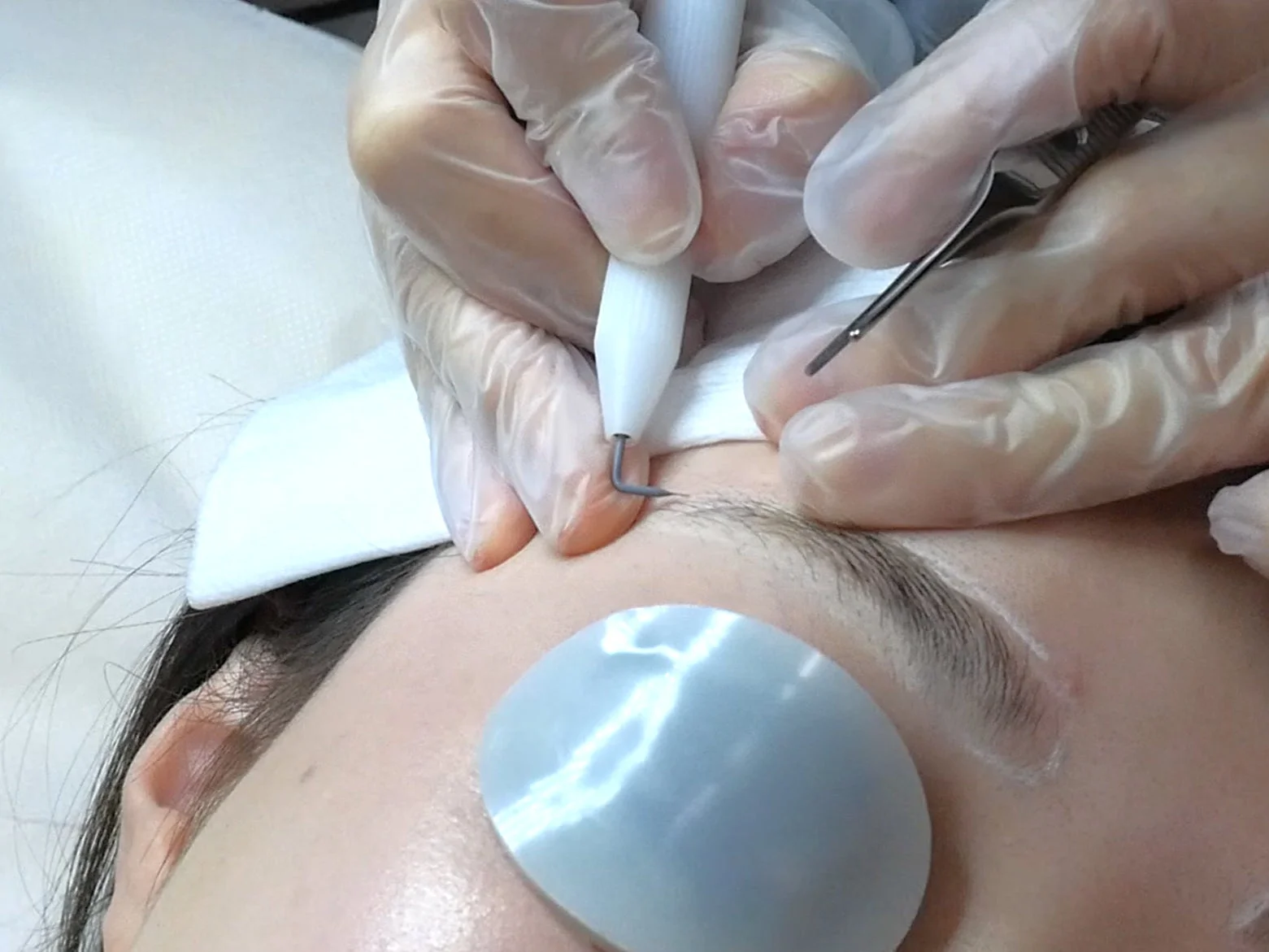 ニードル脱毛施術