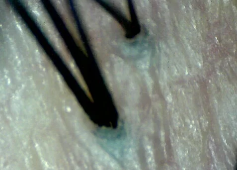 毛穴から毛髪が生えている拡大画像