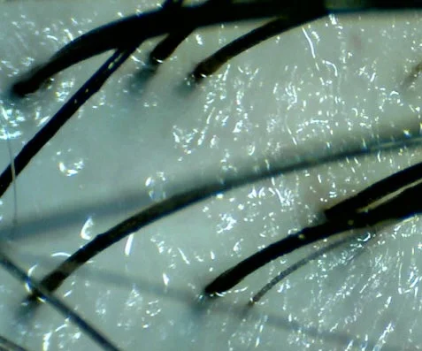 油分または水分がある頭皮の拡大画像