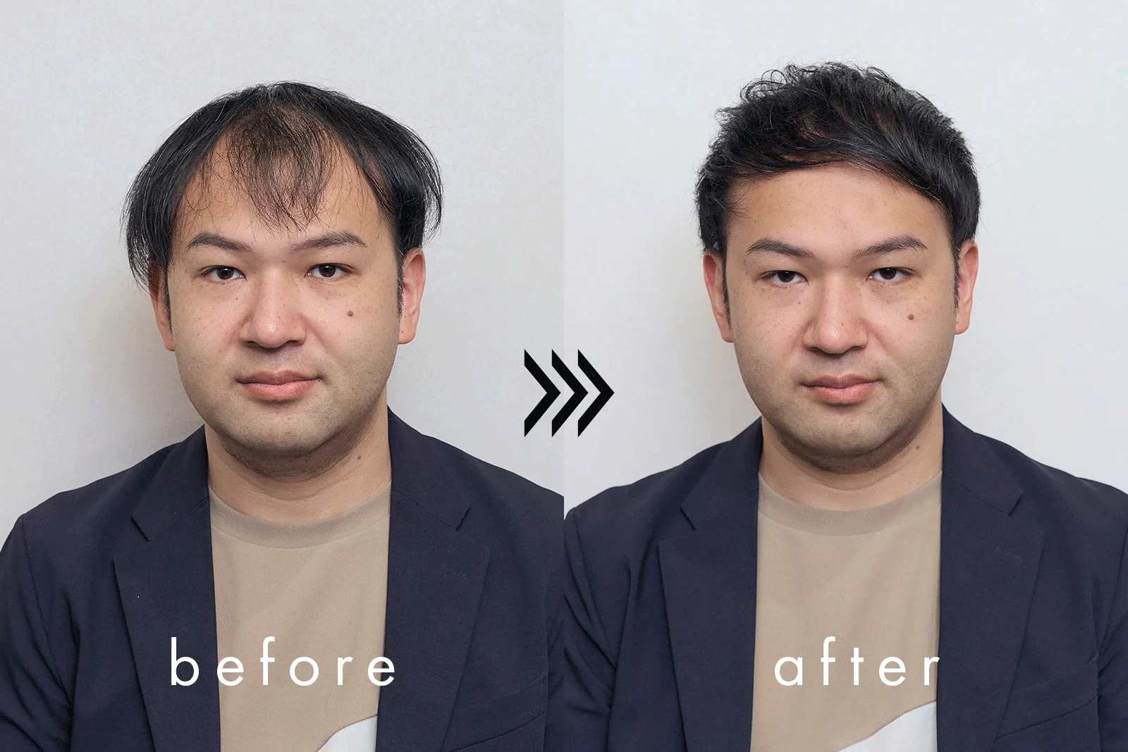 薄毛に悩む男性のビフォーアフター